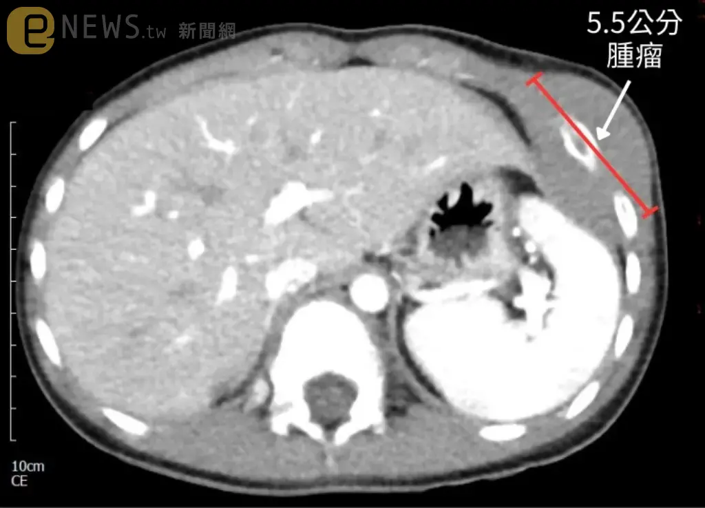 9歲男童「左胸壁腫大隆起＋右大腿疼痛」遲遲好不了　就醫檢查竟是惡性淋巴癌