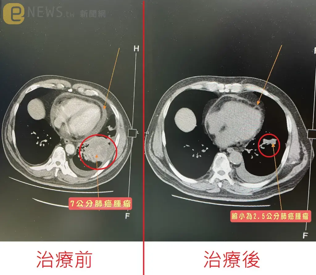 56歲小黃運將「開車喘、累」以為老化　就醫檢查抽出800C.C.血水：癌症末期了