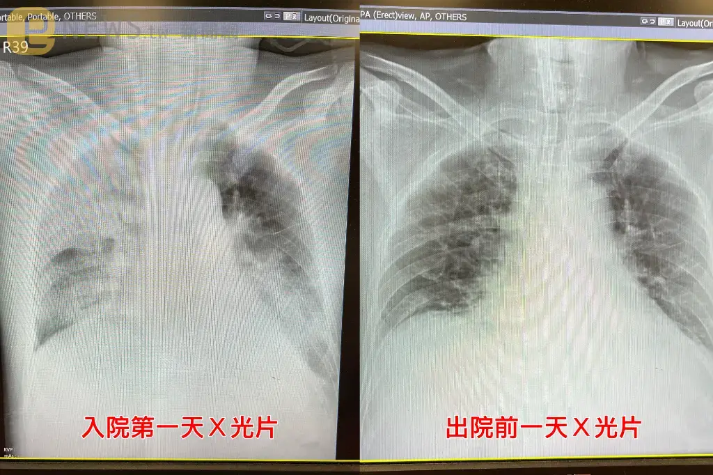 57歲男子騎車半路突呼吸困難摔倒　送醫確診Ａ型流感呼吸衰竭一度病危