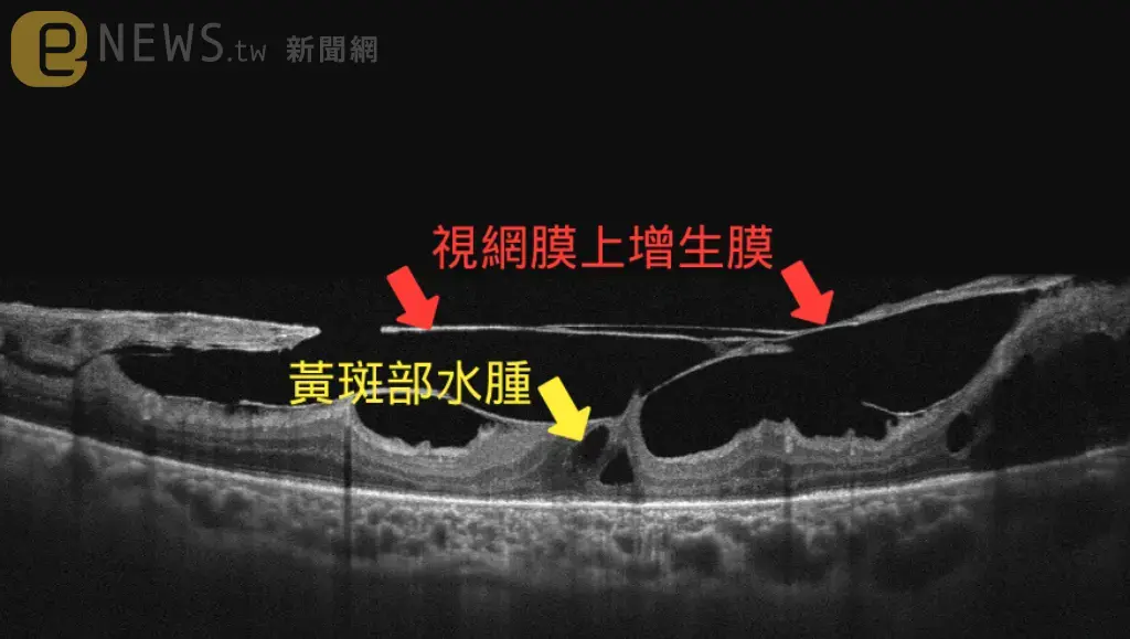 無視危機60歲男子險瞎！　醫示警：「糖尿病視網膜病變」造成許多糖友失明